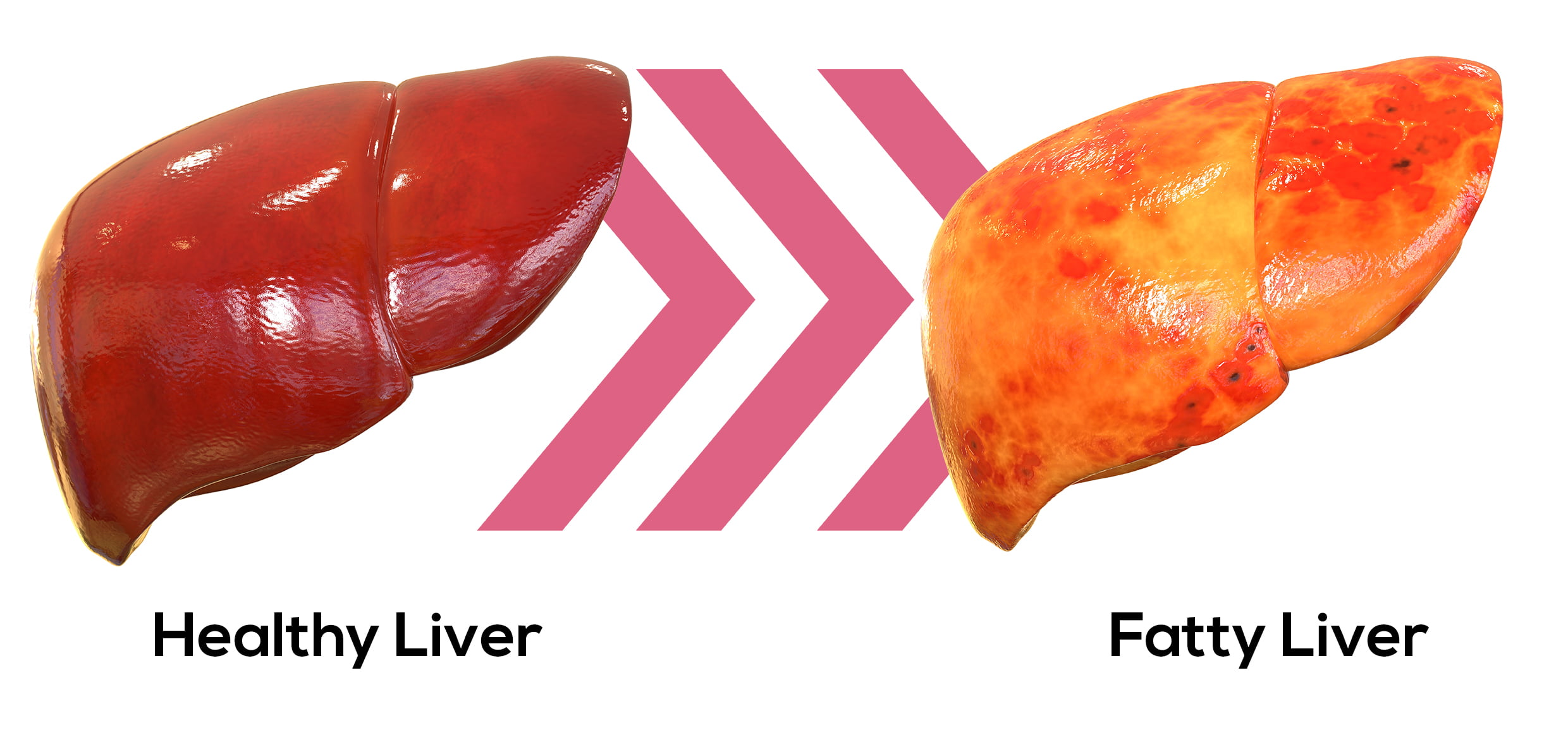 What Is Fatty Liver